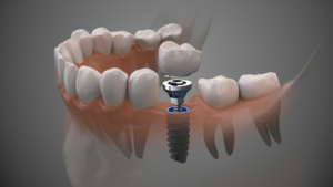 dental implants