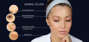 dermal fillers